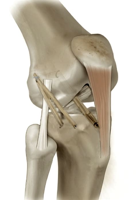 graft for anterior cruciate ligament reconstruction